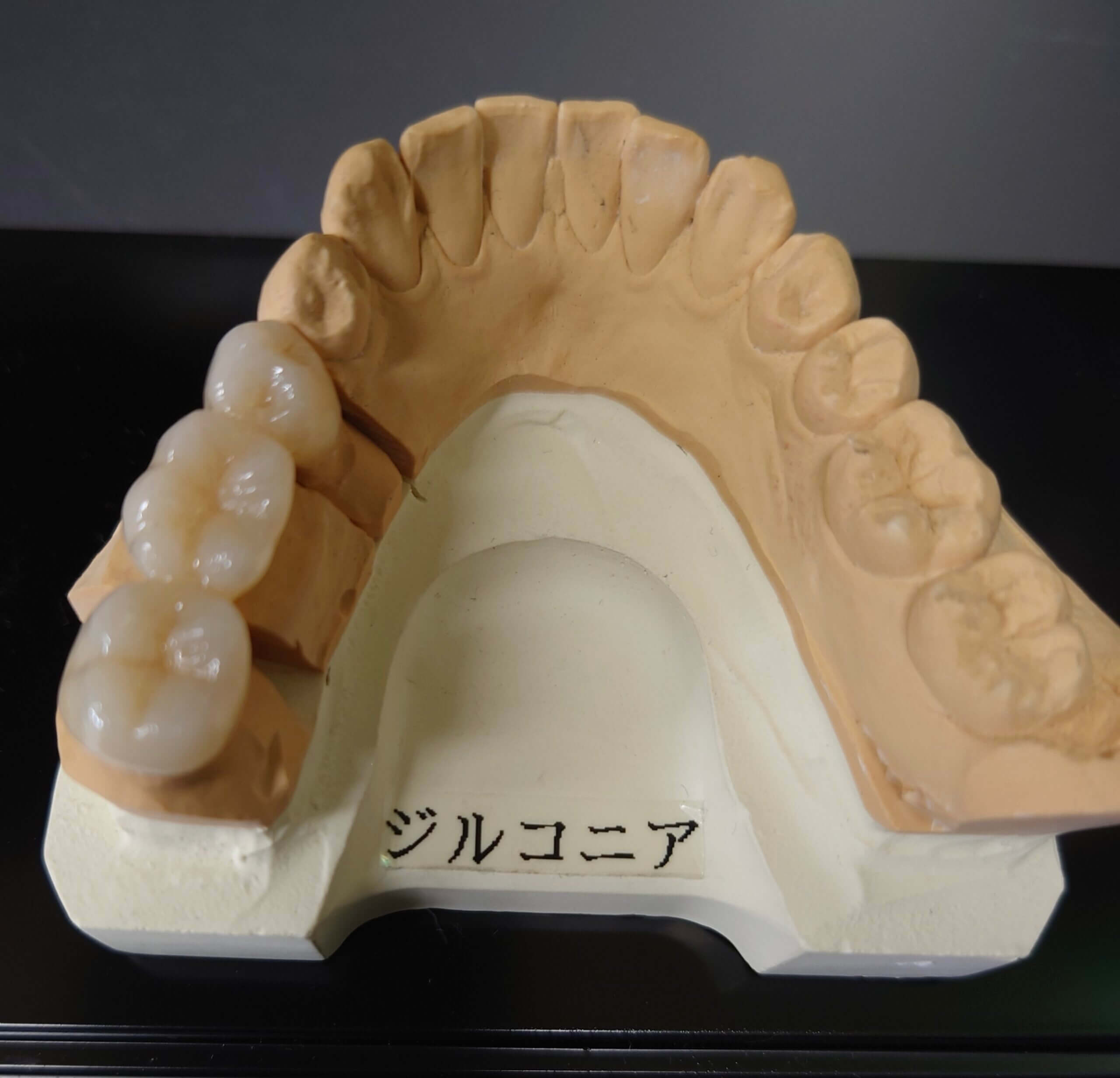 白い歯の被せ物 ジルコニアって 長野フォレスト歯科 白い歯の被せ物 ジルコニアって 長野フォレスト歯科