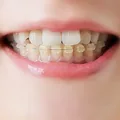 ワイヤー矯正